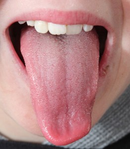 This is the tongue of the same child above. The apparently strange shape of this tongue is an effect of the camera capturing the tongue trembling and jerking. He was unable to hold his tongue out with stillness. 
