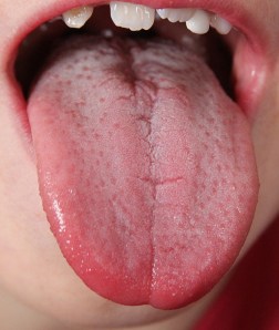 Tongue 3: The most prominent feature of this tongue is heat throughout the tongue and inflamed papillae across the surface of the tongue. 