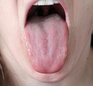 Tongue Body:  Note the  scalloping on the sides of the tongue body, the tongue has a slightly swollen appearance, with one side more prominently swollen than the other.   These are signs of dampness. 